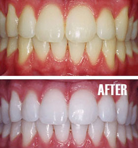 Before and After Shots - Teeth Whitening at Arizona Healthy Smiles in Tempe, Arizona
