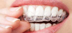 Clear Trays for Teeth Whitening at Arizona Healthy Smiles in Tempe, Arizona